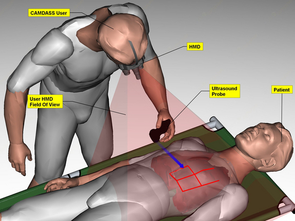 The Computer Assisted Medical Diagnosis and Surgery System, CAMDASS, is a wearable augmented reality prototype. Augmented reality merges actual and virtual reality by precisely combining computer-generated graphics with the wearer’s view. CAMDASS is focused for now on ultrasound examinations but in principle could guide other procedures.